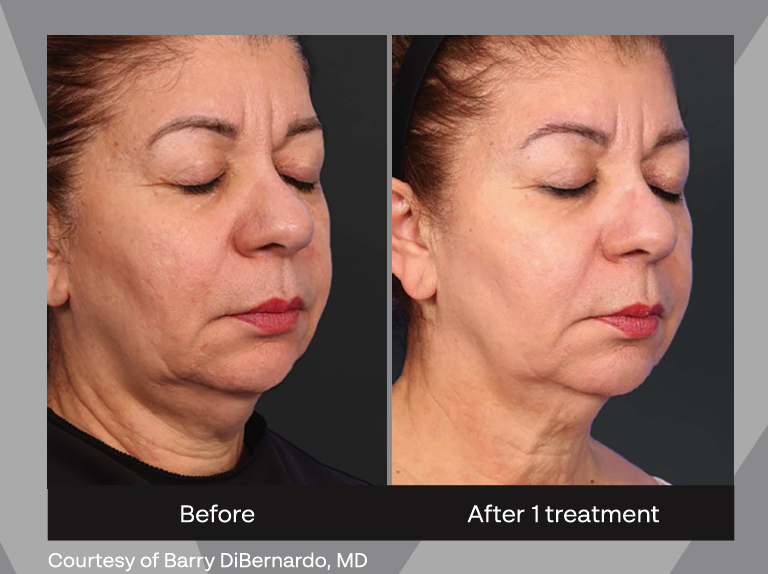 Xerf before and after