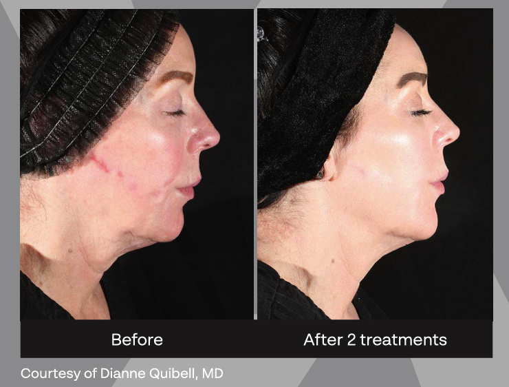 Xerf before and after